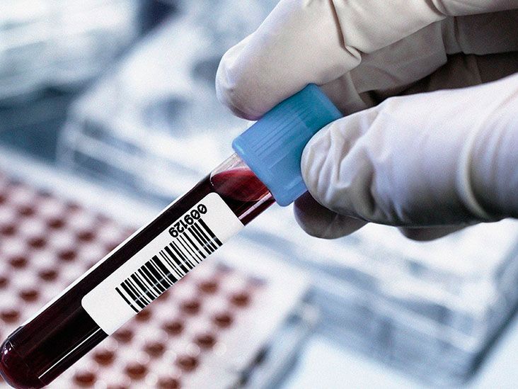 Rheumatoid factor Ranges, tests, and treatment