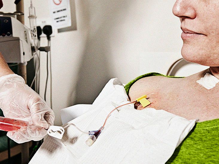 What to know about diffuse large B-cell lymphoma (DLBCL)