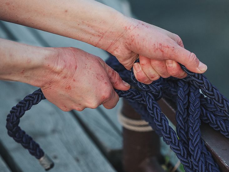 Is eczema an autoimmune disease? What to know