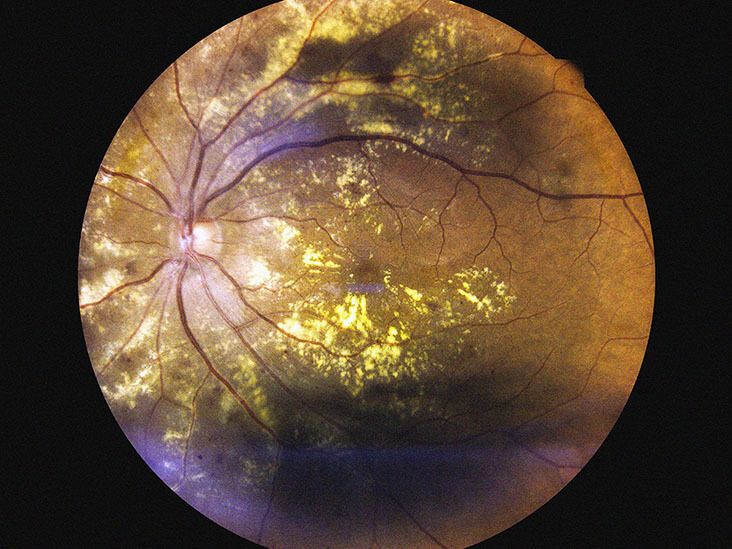 What is dry age-related macular degeneration (AMD)?