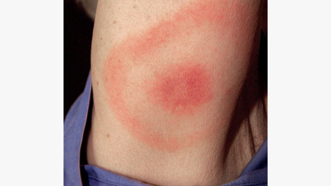 Ringworm: Symptoms, Pictures, Treatment, Diagnosis, and More