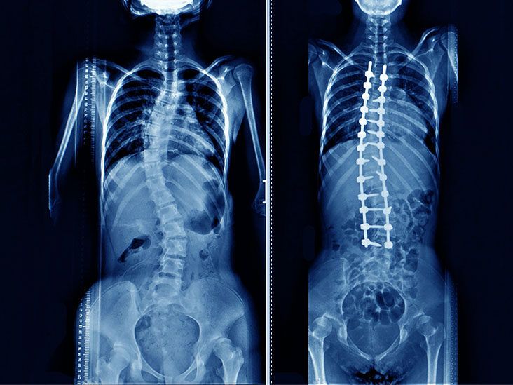 Milwaukee Brace vs New Scoliosis Braces: Which Is Better?