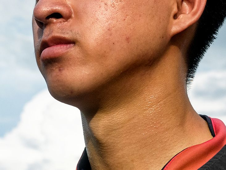 Antibiotics for acne Topical, oral, and other options