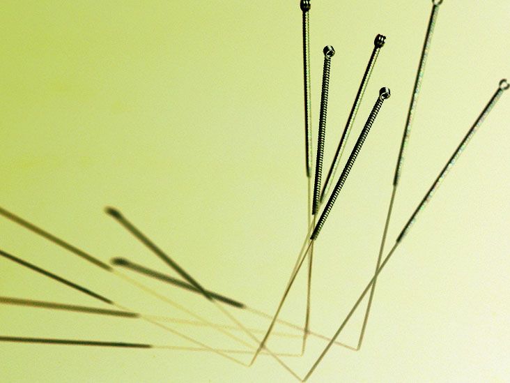 Can acupuncture help relieve pain due to shingles?