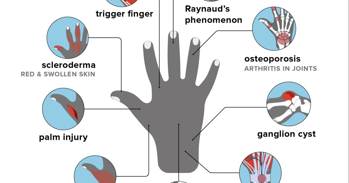 Why Does My Right Hand Hurt For No Reason