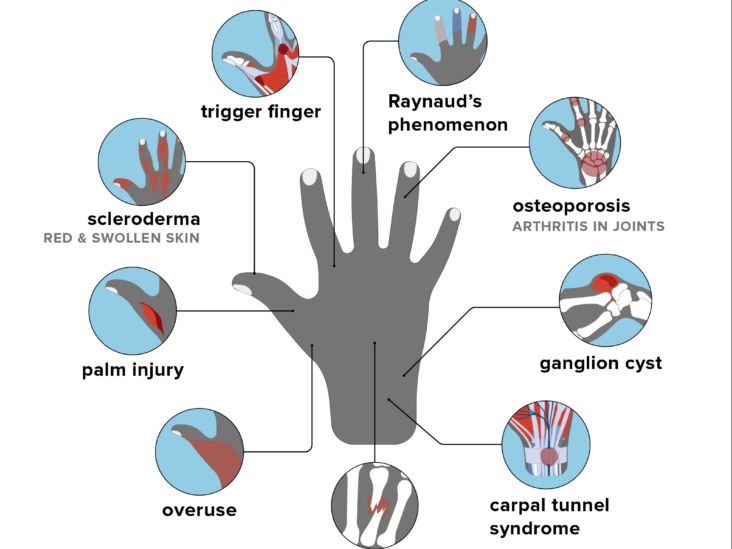 Hand Pain, 8 Hand Pain Causes & When to See a Doctor