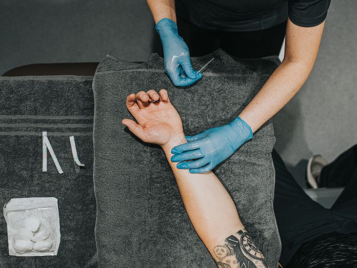 Acupuncture for carpal tunnel syndrome What to know