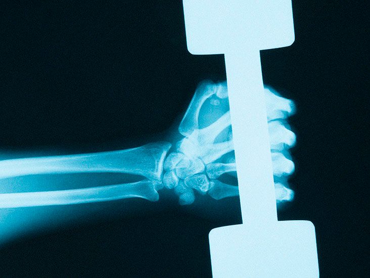 Calcium phosphate What is it and what are the risks?