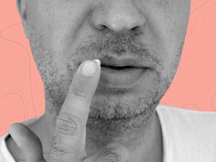 Cold sore medication Types, benefits, and how to use