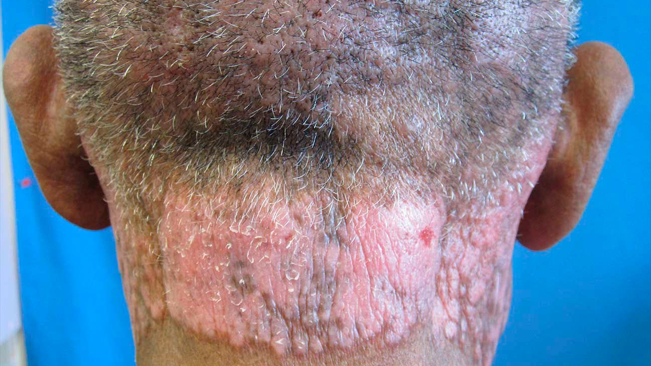 hiv lesions back