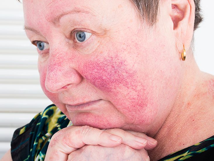 Laser treatment for rosacea Results, risks, and cost