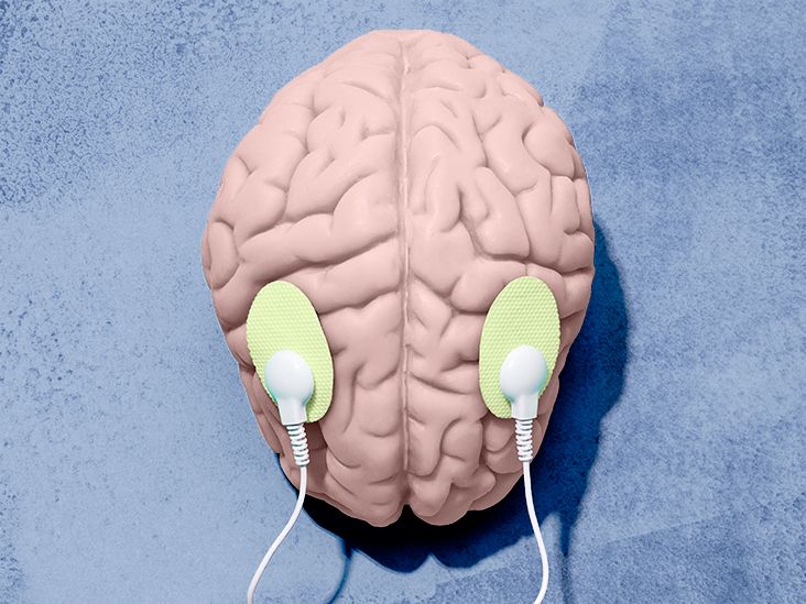 Long COVID Can brain stimulation treat 