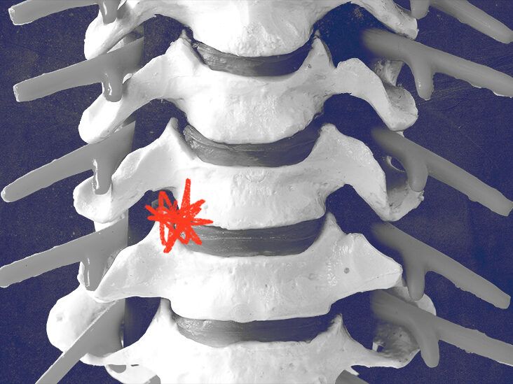 Degenerative disc disease: Causes and treatment