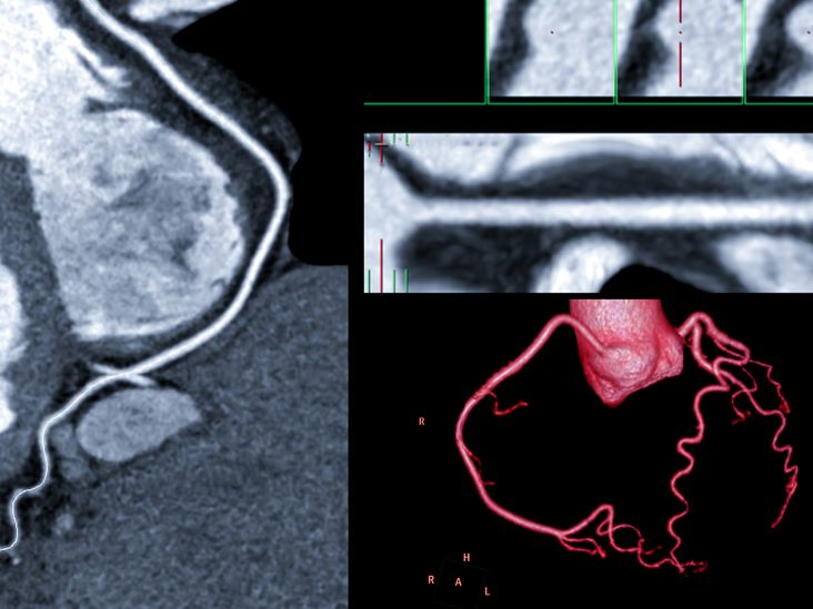What is a coronary artery fistula?