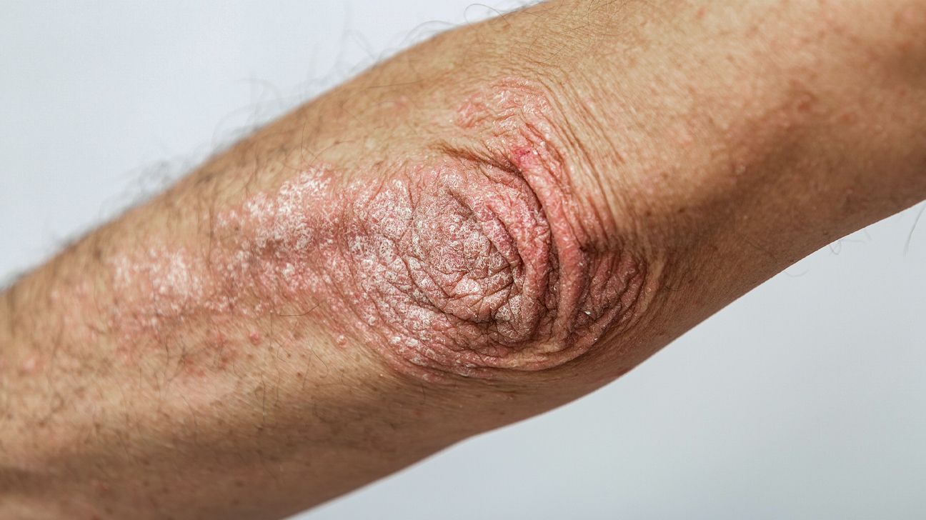 Tinea manuum: Pictures, symptoms, and treatments
