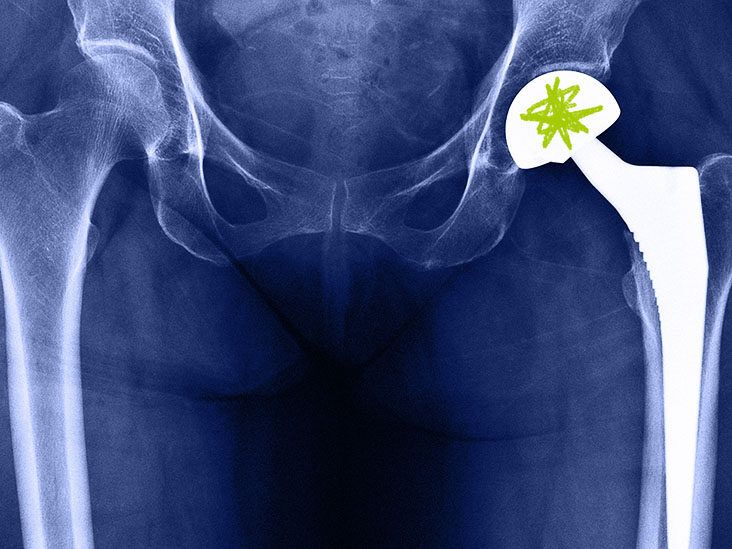Hip replacement recovery: Timings and what to expect