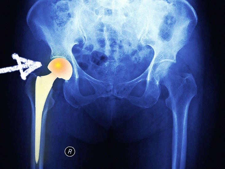 Total Hip Replacement - OrthoInfo - AAOS