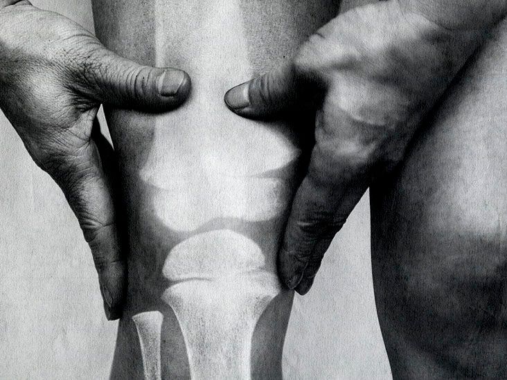 What to know about parathyroid hormone and osteoporosis