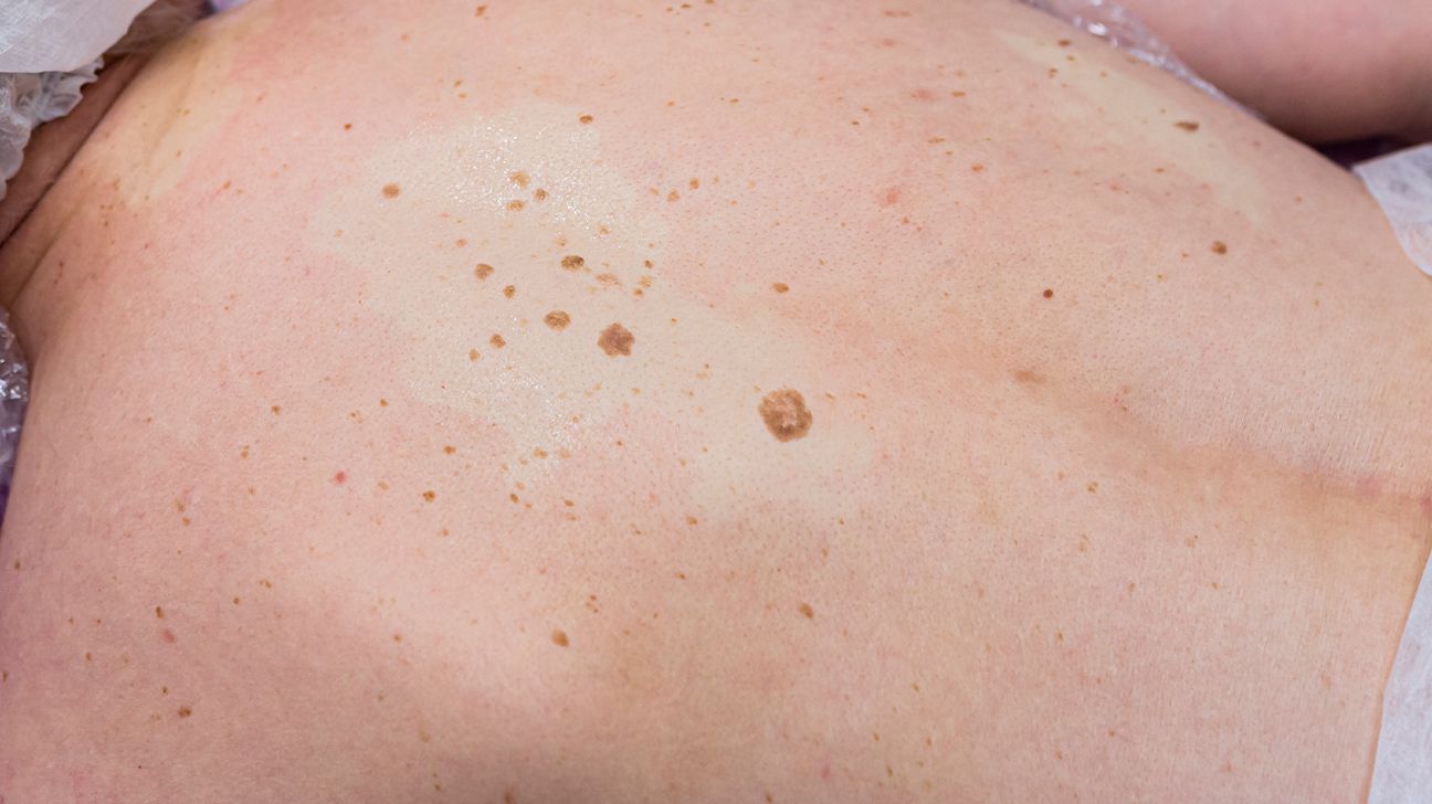 What Is the Cause of These Waxy, Dermal Papules?