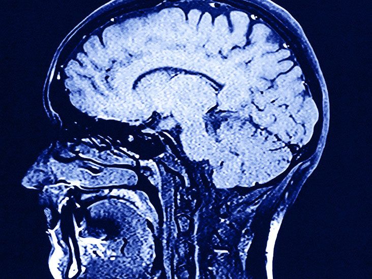 Lissencephaly Ultralyd Living With… Lissencephaly