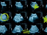 Abnormal Results For Liver Ultrasound What Can They Mean 