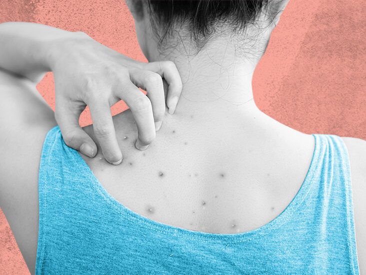 Shoulder acne: Types, causes, and how to get rid of it