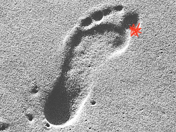 Big toe arthritis Causes, symptoms, and treatment