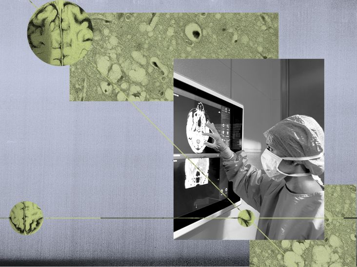 Prion disease: Definition, symptoms, treatment, and more