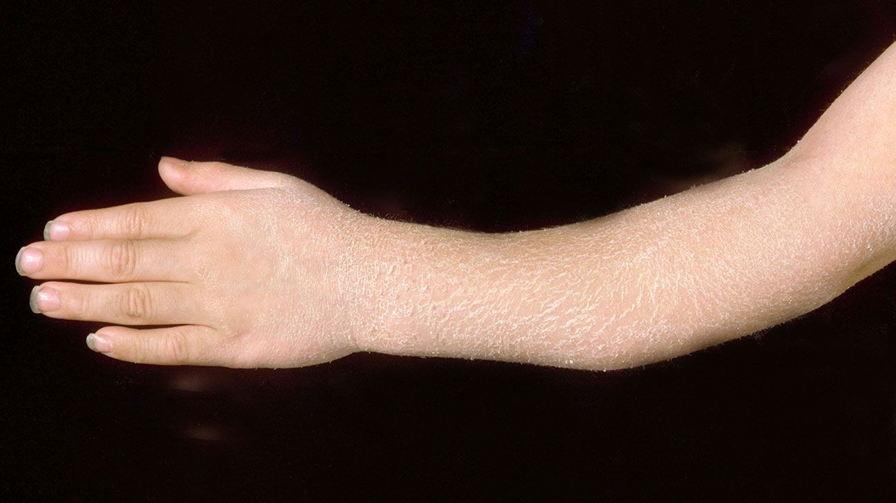 Broken arm Symptoms causes pictures and treatment