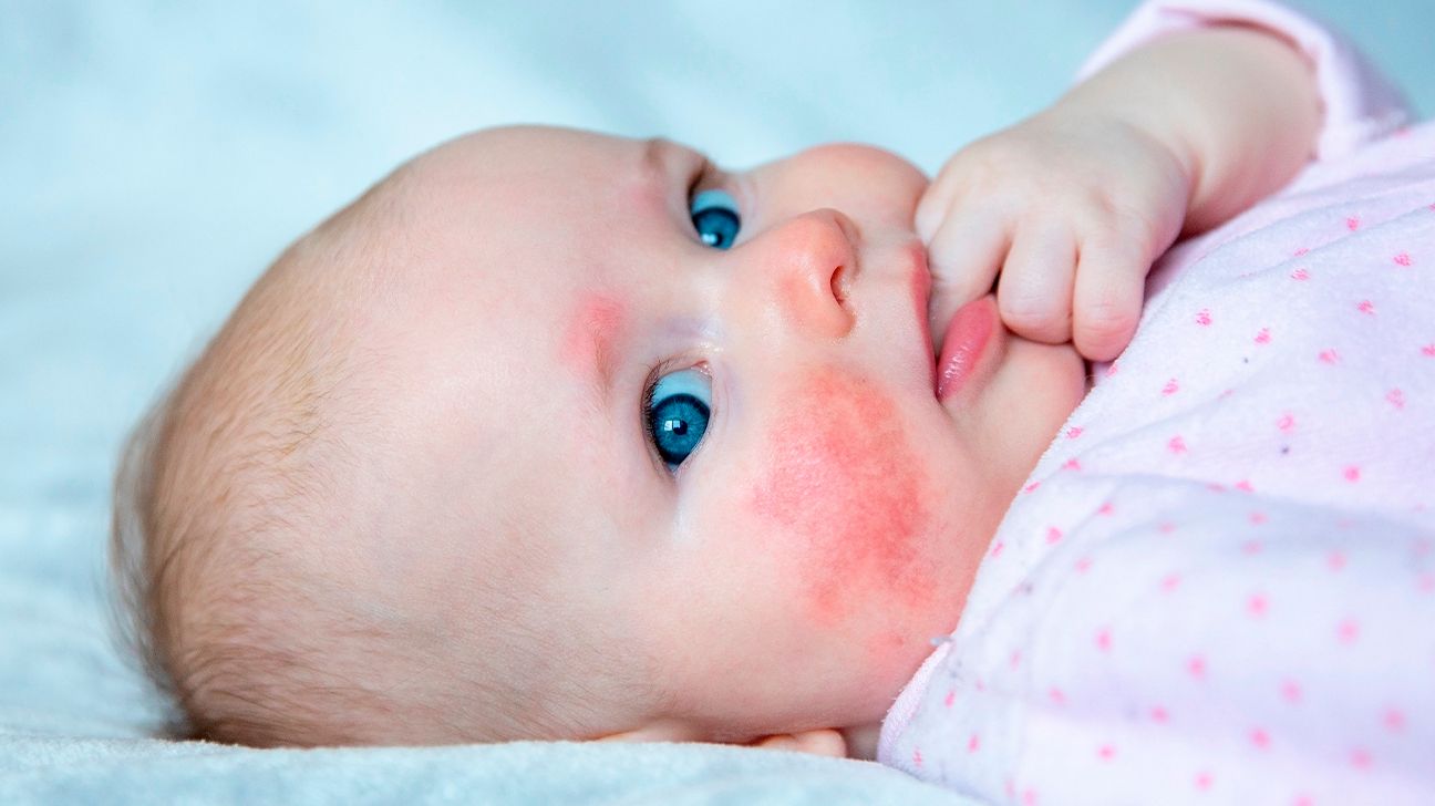 allergic reaction rash baby