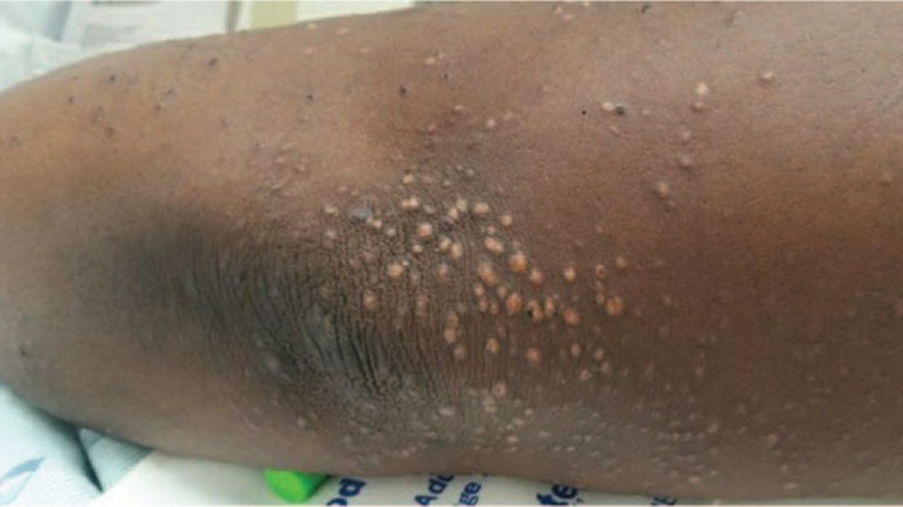 Carnivore diet' caused yellow lumps to grow on man's hands and feet | Live  Science, image size:1296x728