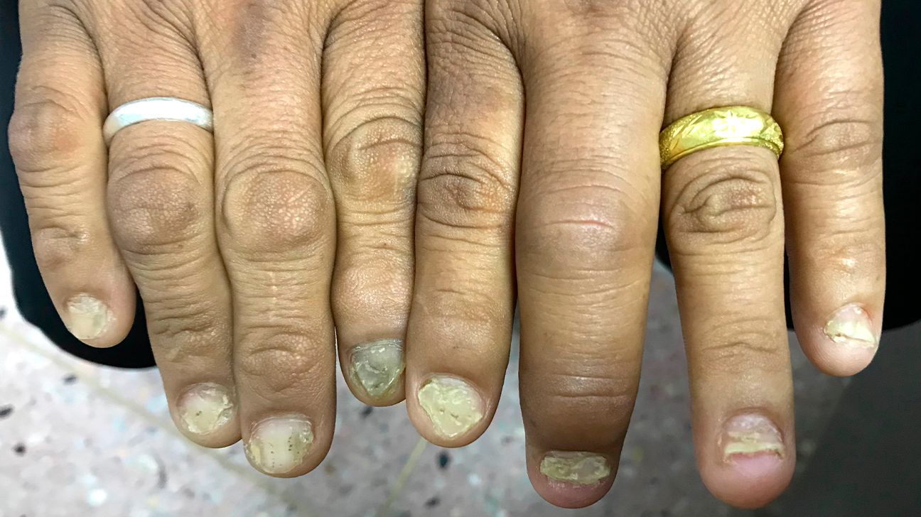 Severe 20-nail psoriasis successfully treated by low dose methotrexate