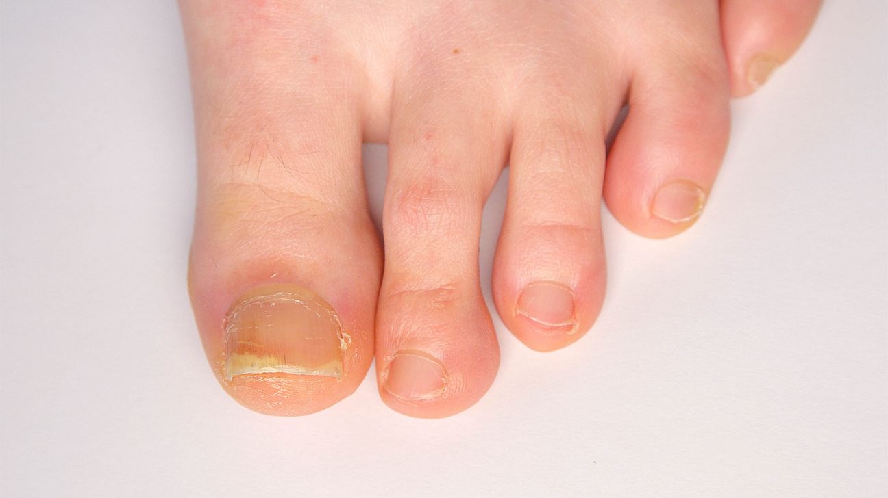 Fractional CO2 laser in the treatment of nail psoriasis: how can it help? |  Archives of Dermatological Research