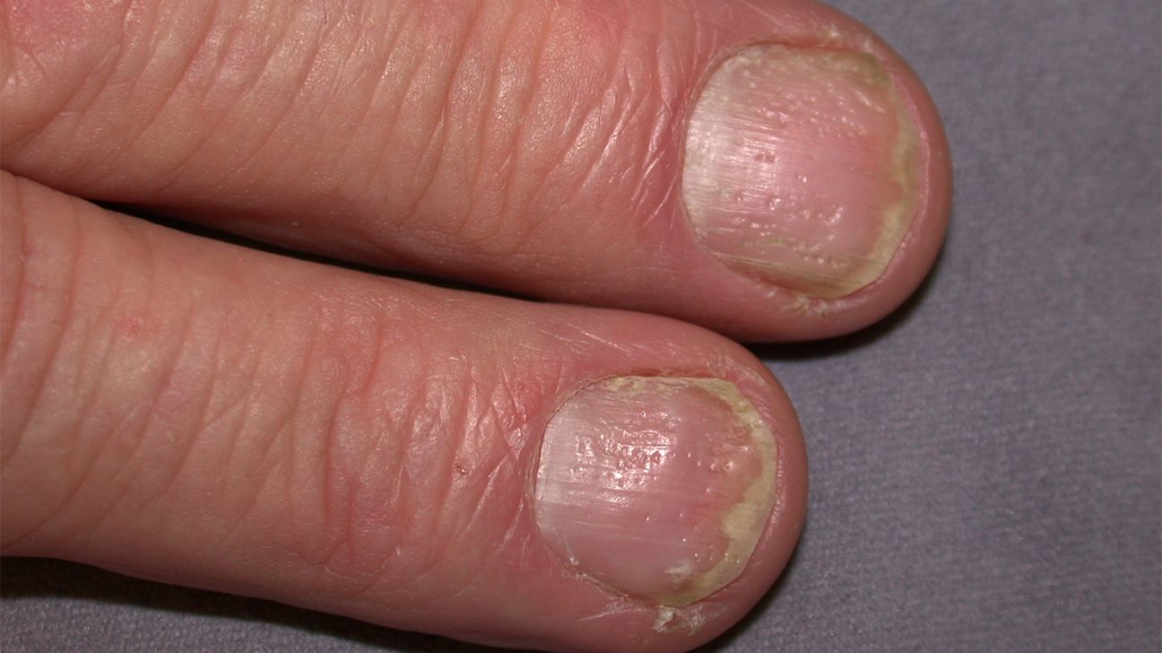 Figure 2 from Psoriatic arthritis and nail changes: exploring the  relationship. | Semantic Scholar