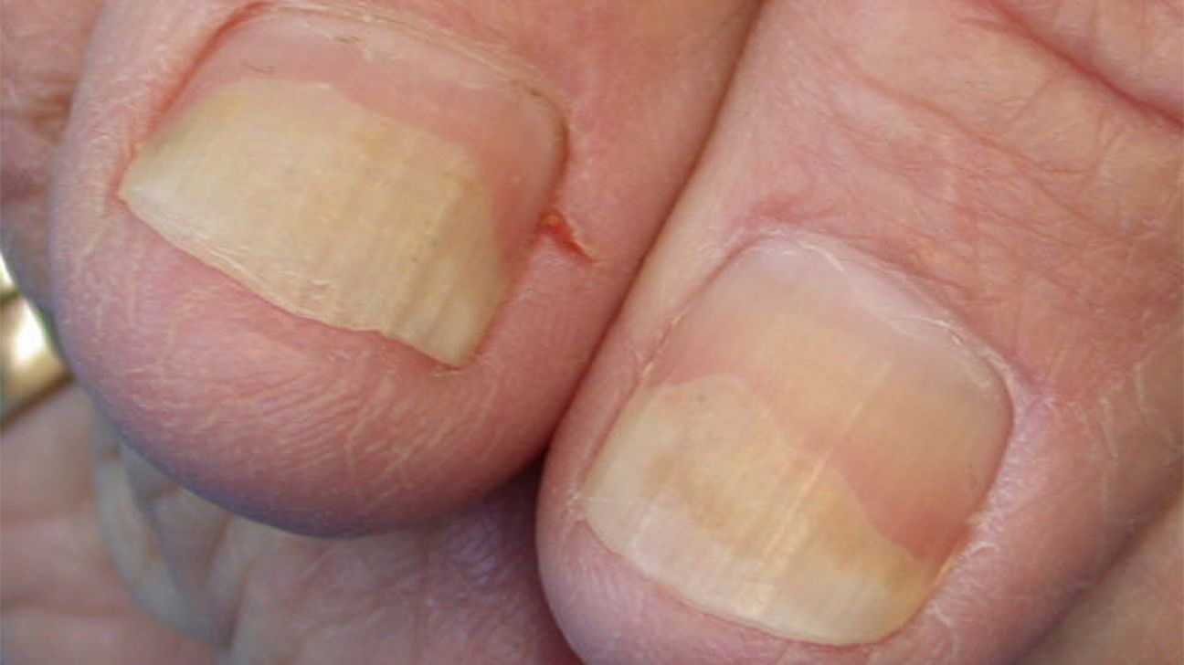 Although nail fungus and nail psoriasis share many resemblances, they are  actually two different conditions that need different treatment... |  Instagram