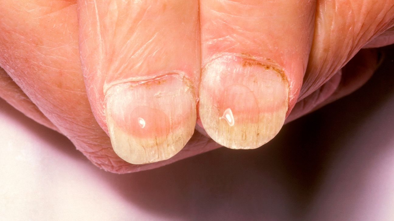 Do You Recognize These Nail Disorders? | Consultant360