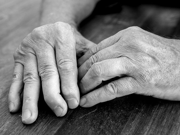 Psoriatic arthritis in the hands: Symptoms, pictures, and treatment