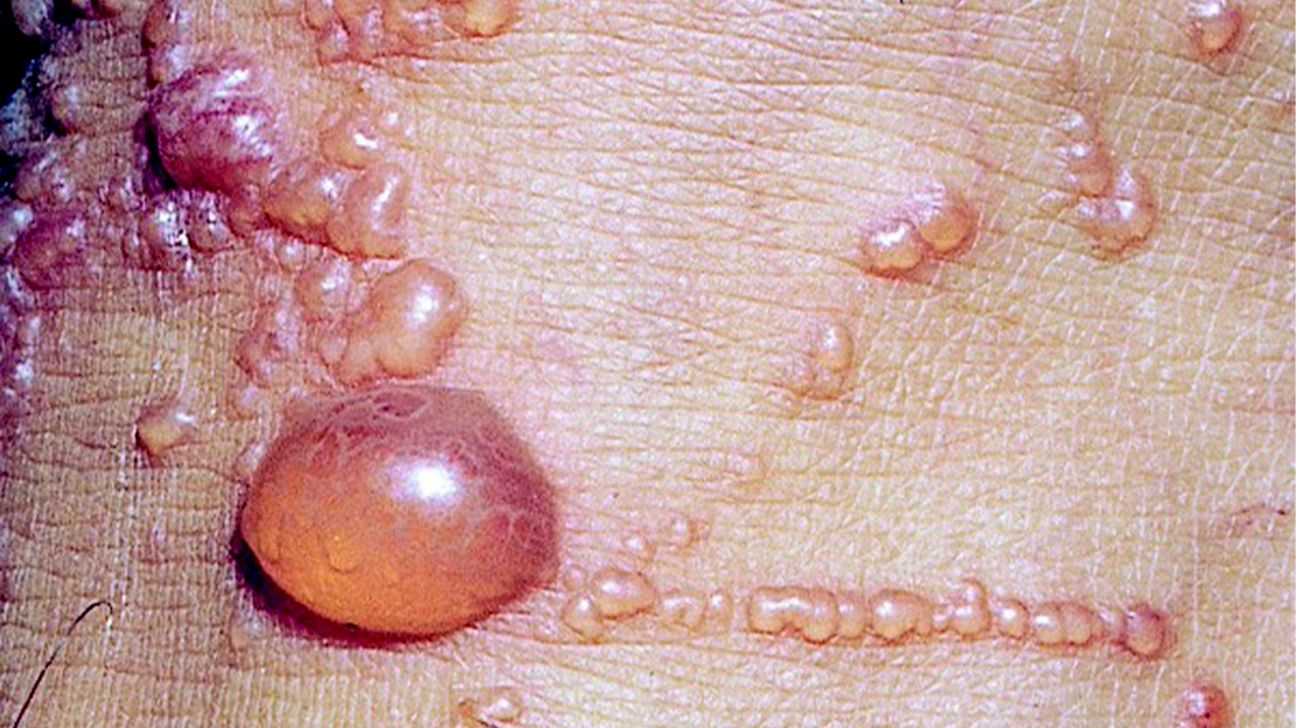 Rash★ Shingles vs. poison ivy: How to tell the difference