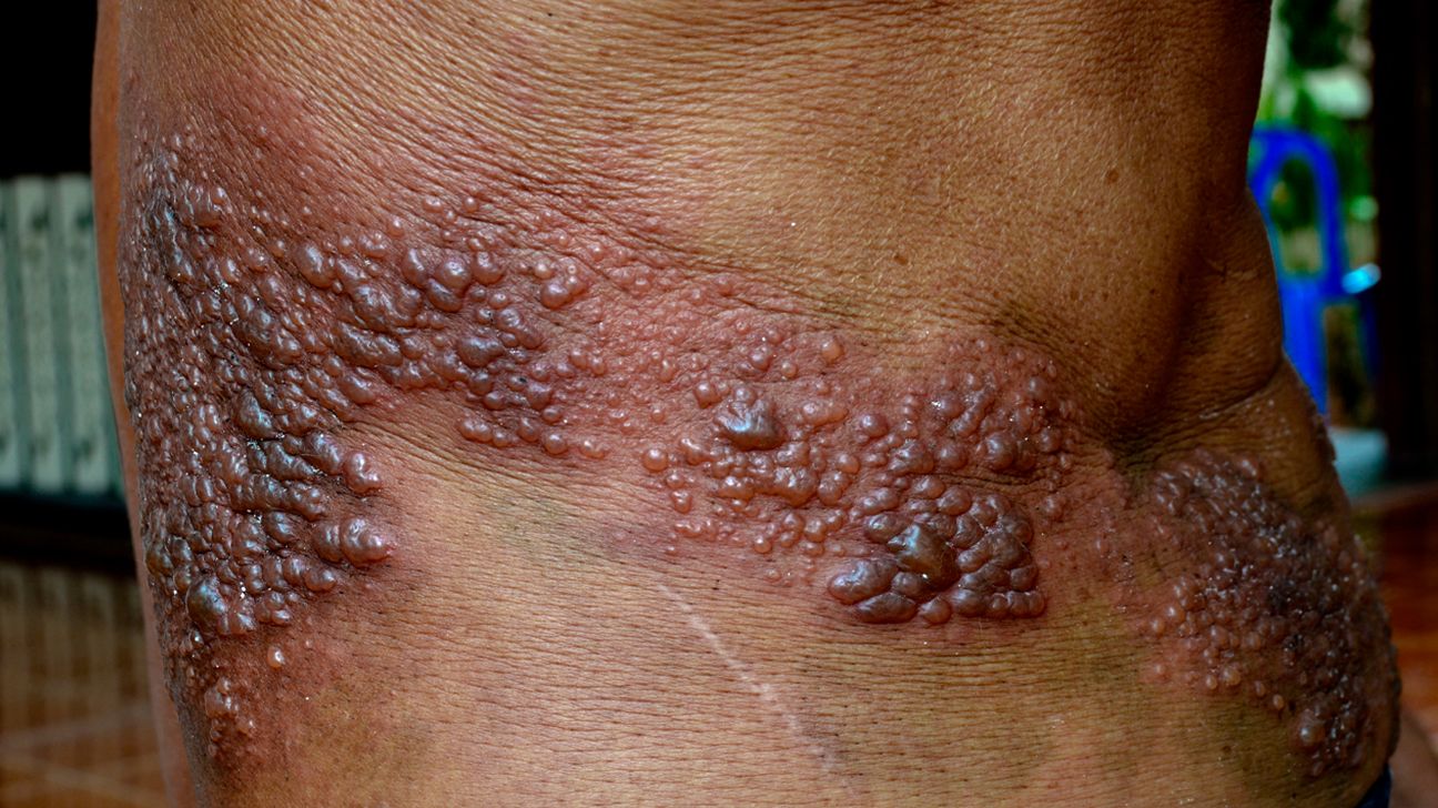 Rash★ The patterns of my son's awful rash look like numbers : r
