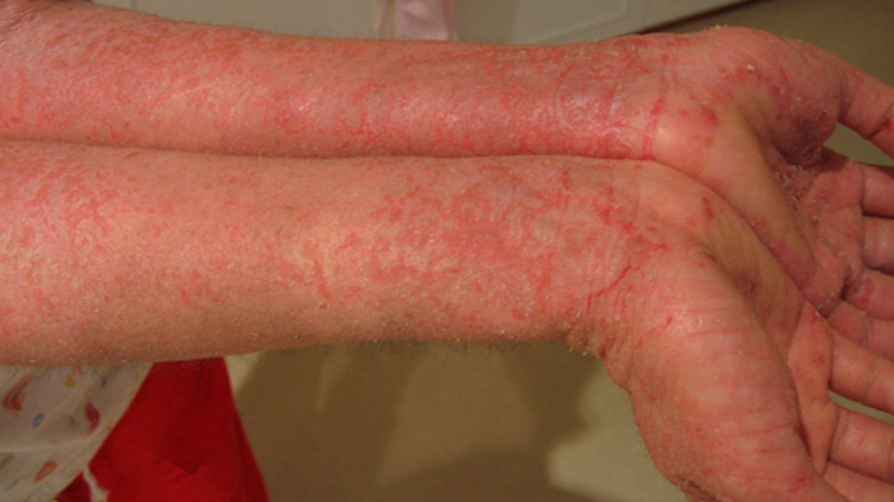 Skin Rash, Urticaria, Allergic Skin Reaction. Stock Image - Image of  allergist, irritated: 93000603