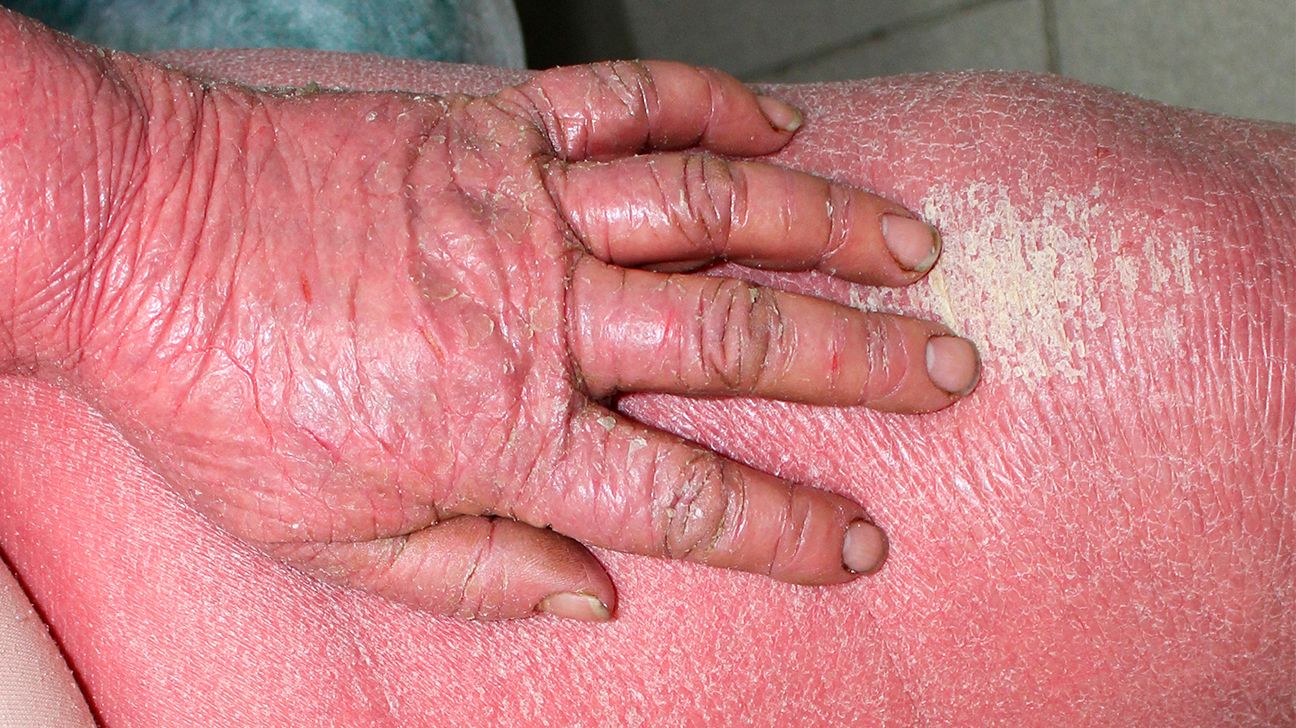 Old Woman Irritated Skin Under Bra Stock Photo 1498857482