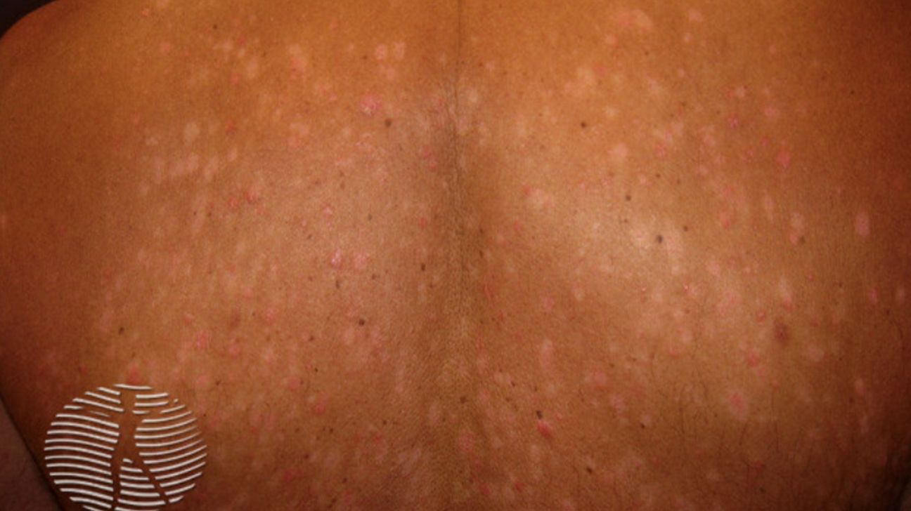 Premium Photo  Female torso with red allergic rash on stomach