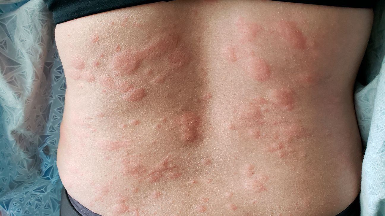 Skin Rash And Itchy Back Acne. Dry Eczema Allergy Stock Photo - Alamy