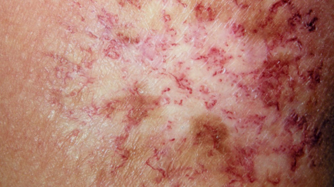 Pictures of common skin rashes, symptoms & treatments