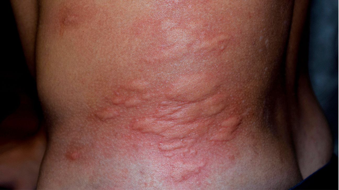Anybody know what rash this is? It's on my lower back right above my underwear  line and it's itchy : r/DermatologyQuestions