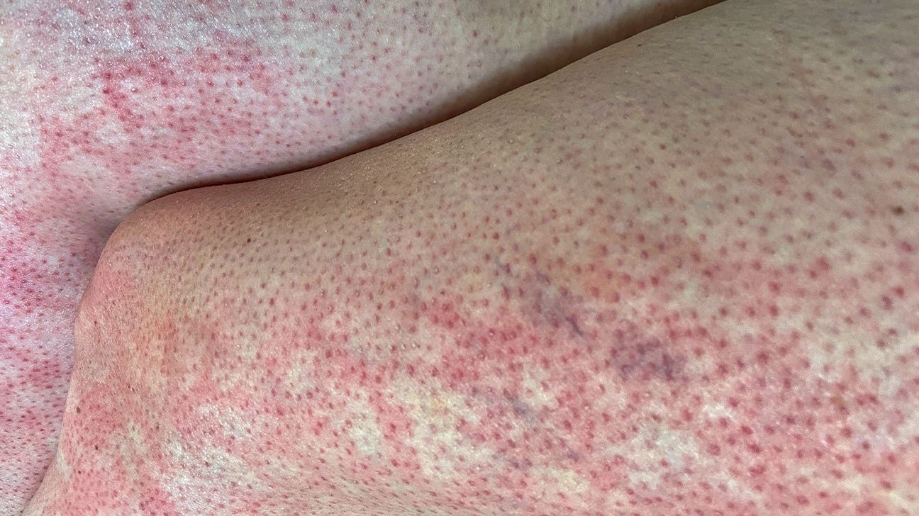 Red rash on breast - posting for traffic please help (pic included)