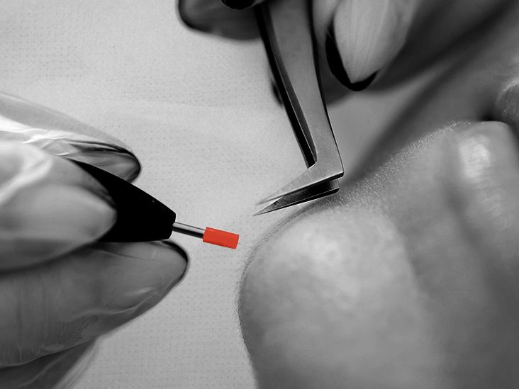 Electrolysis for polycystic ovary syndrome Benefits and costs