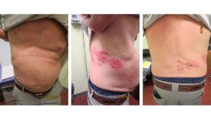 shingles band around the body