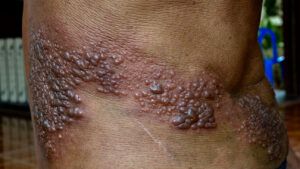 shingles blistering rash
