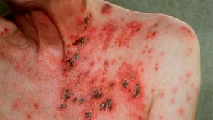 shingles on weakened immune system